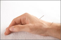 acupuncture treatment